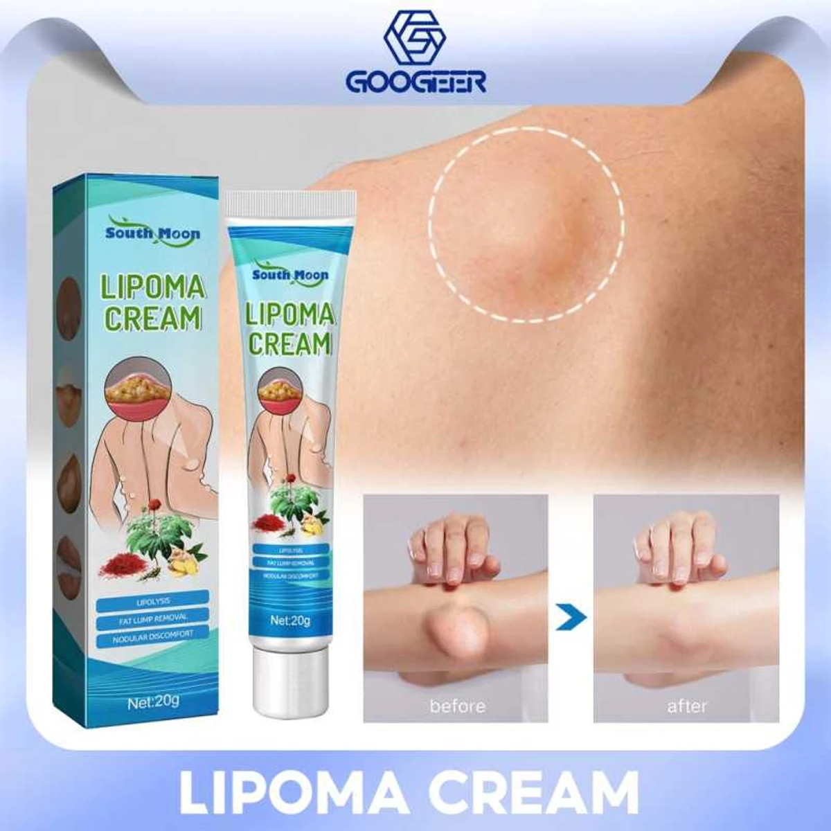 Lipoma Removal Cream-লাইপোমা রিমুভাল ক্রিম>>>
