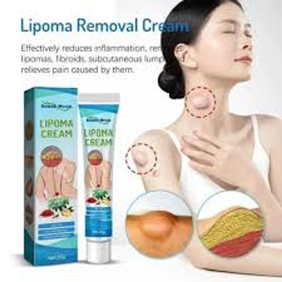 Lipoma Removal Cream-লাইপোমা রিমুভাল ক্রিম>>>